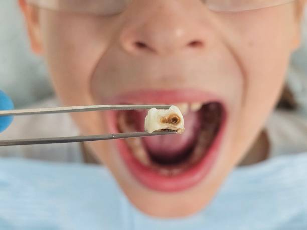 Best Emergency Dental Care for Abscessed Tooth in San Marino, CA