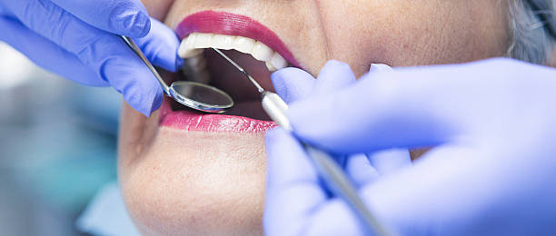 Best Emergency Dental Care for Abscessed Tooth in San Marino, CA